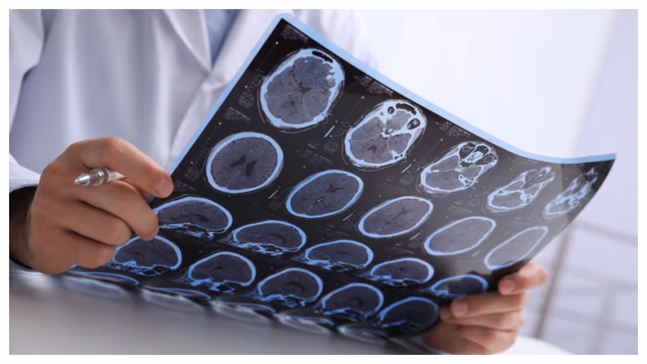 Brain tumour Brain tumour