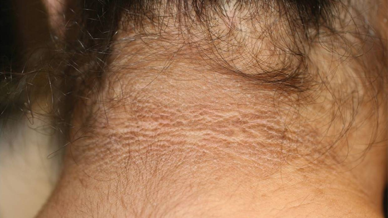 Neck Pigmentation Neck Pigmentation