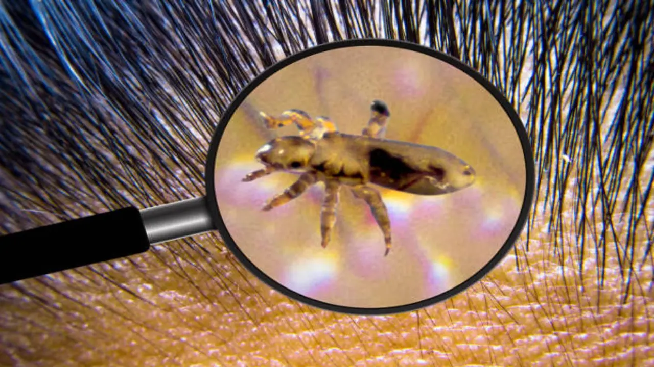 home remedies to get rid of lice and dandruff in one day