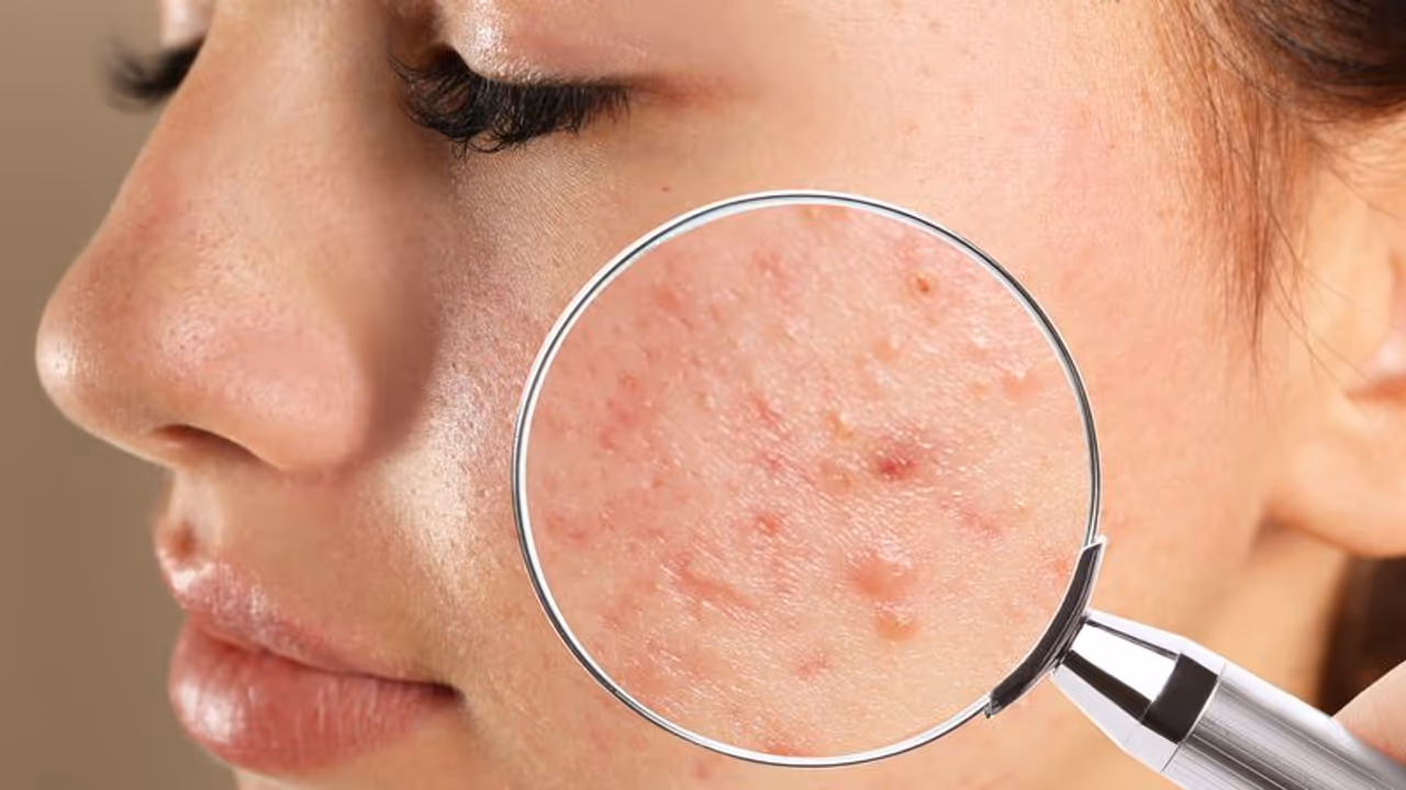 Can Garlic Remove Pimples?