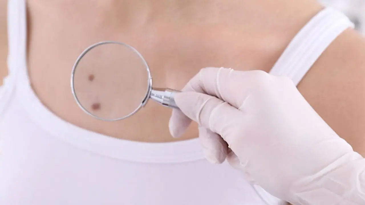 Meaning of mole on heart