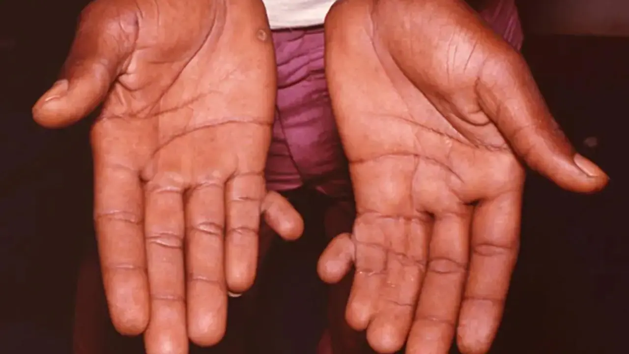 Is having 6 fingers lucky or unlucky Is having 6 fingers lucky or unlucky