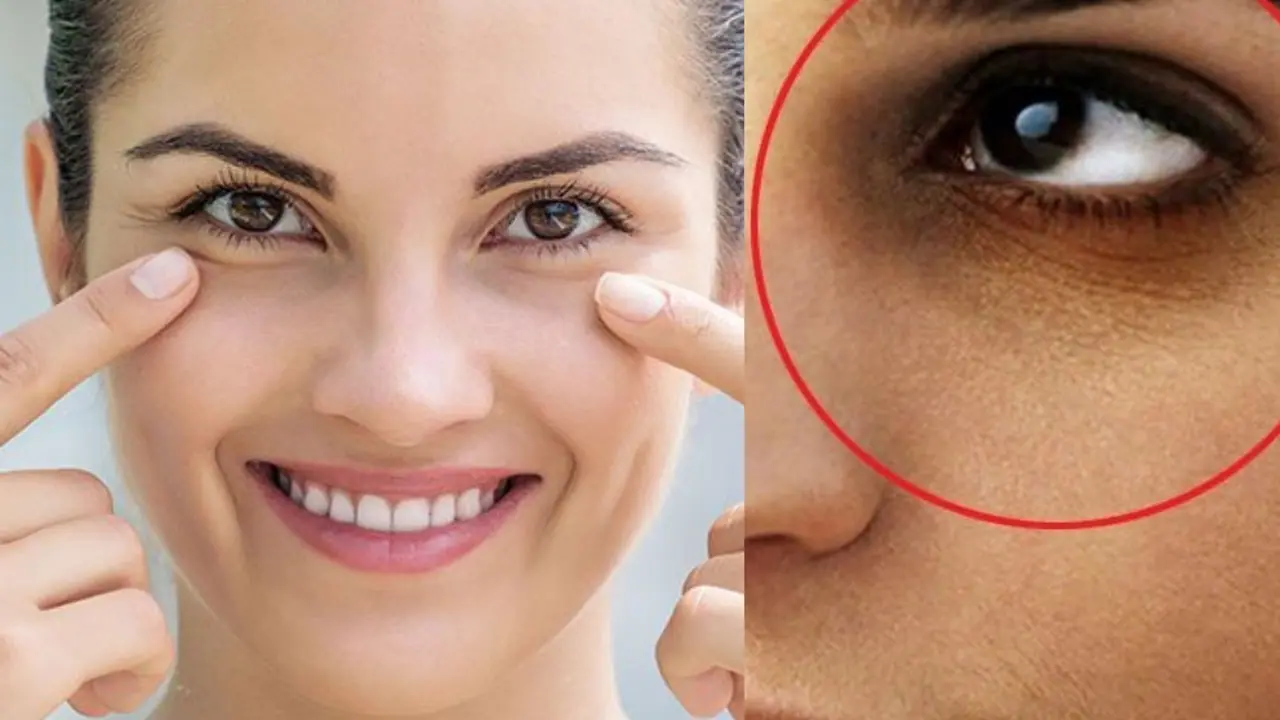Dark Circles Under Eyes Causes Treatment and Prevention