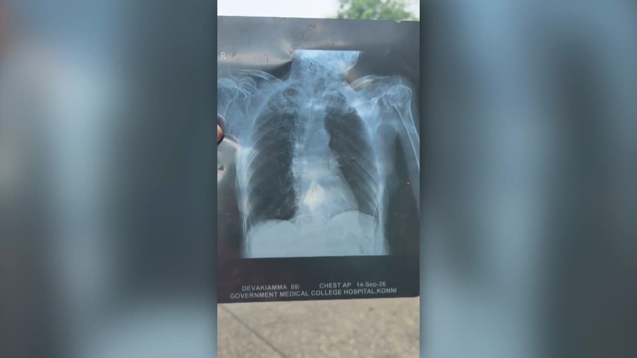 XRAY konni medical college XRAY konni medical college