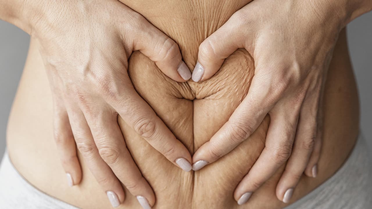 3 homemade scrubs that can remove stretch marks 3 homemade scrubs that can remove stretch marks