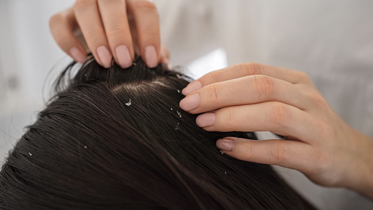 how to get rid of thick dandruff how to get rid of thick dandruff