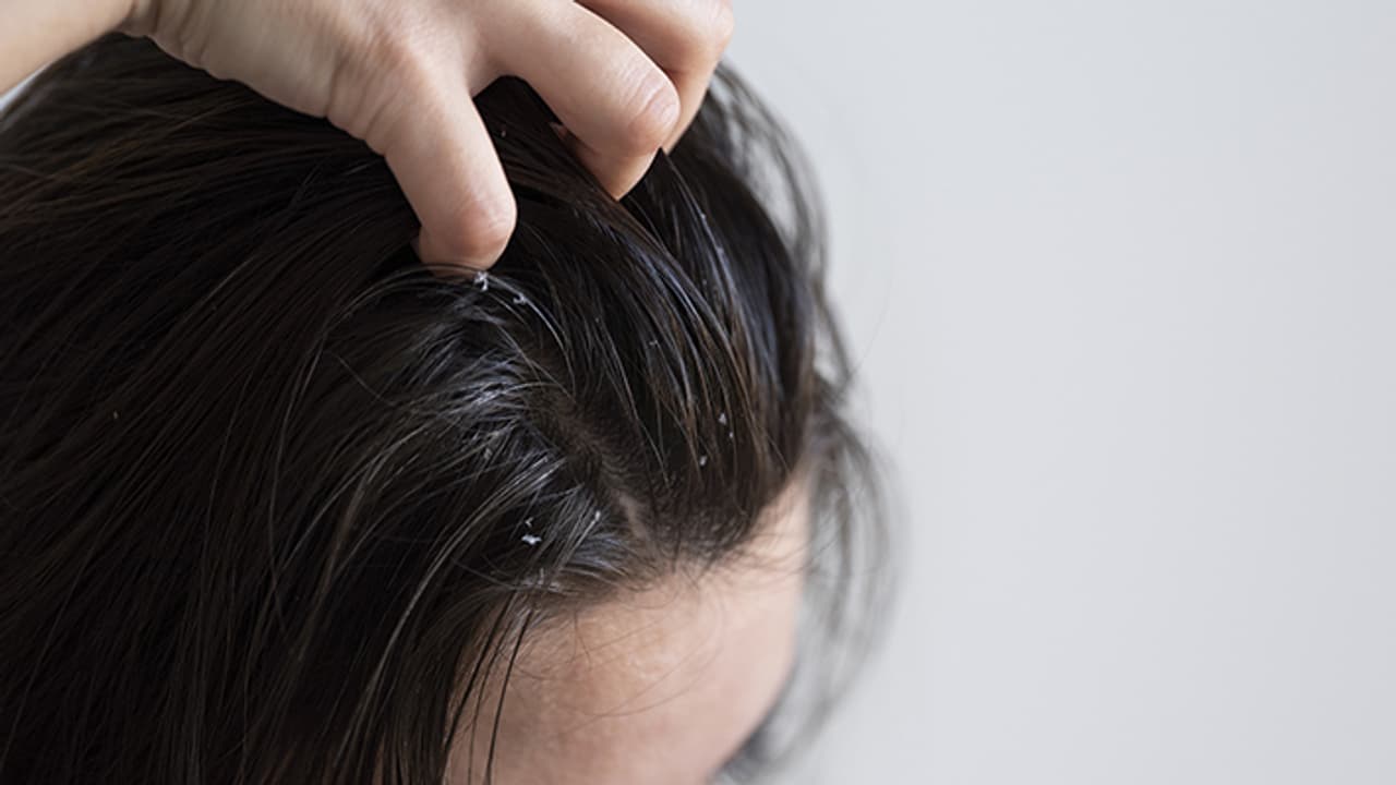 Jawed Habib diy tips for severe dandruff
