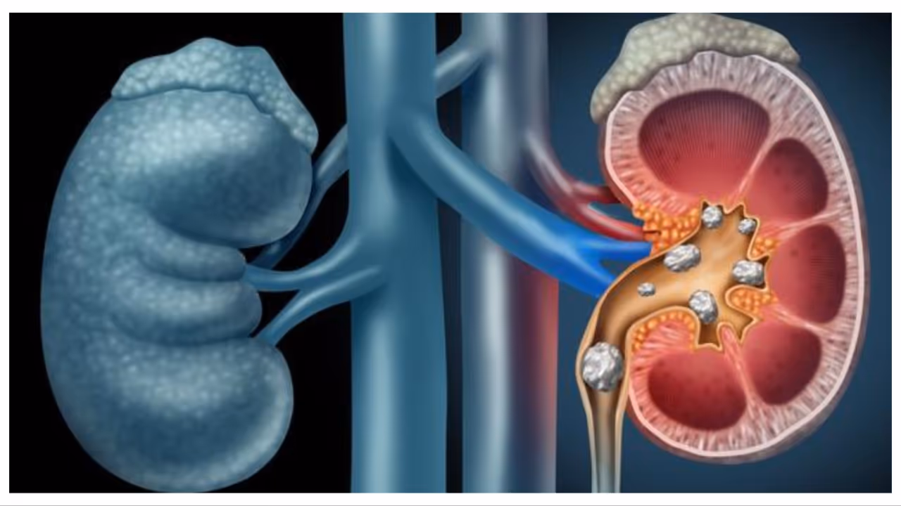 KIDNEY STONE KIDNEY STONE