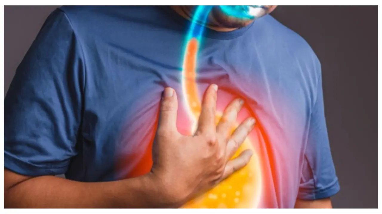 acid reflux acid reflux