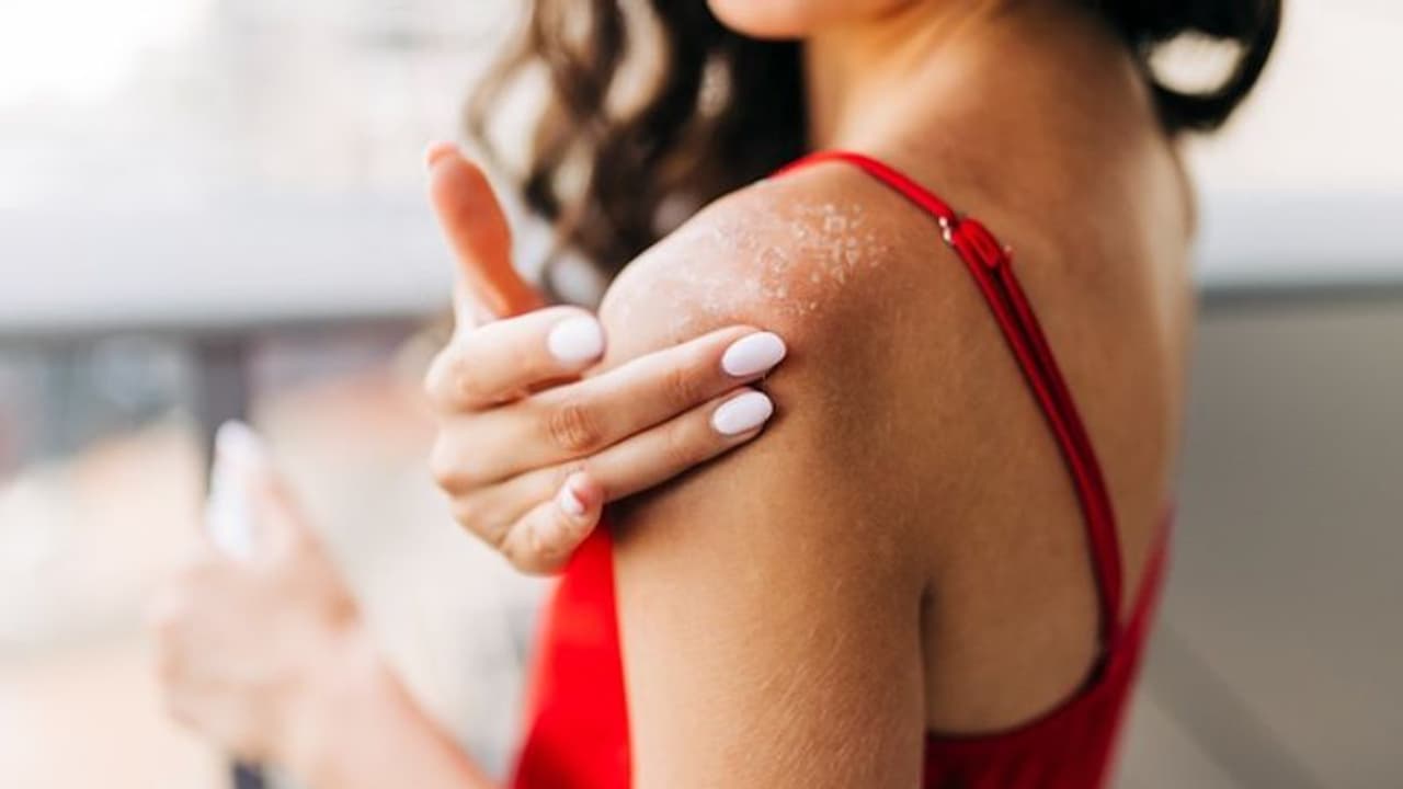 How to protect your skin from heat rashes and sunburns? Here are 5 easy ...