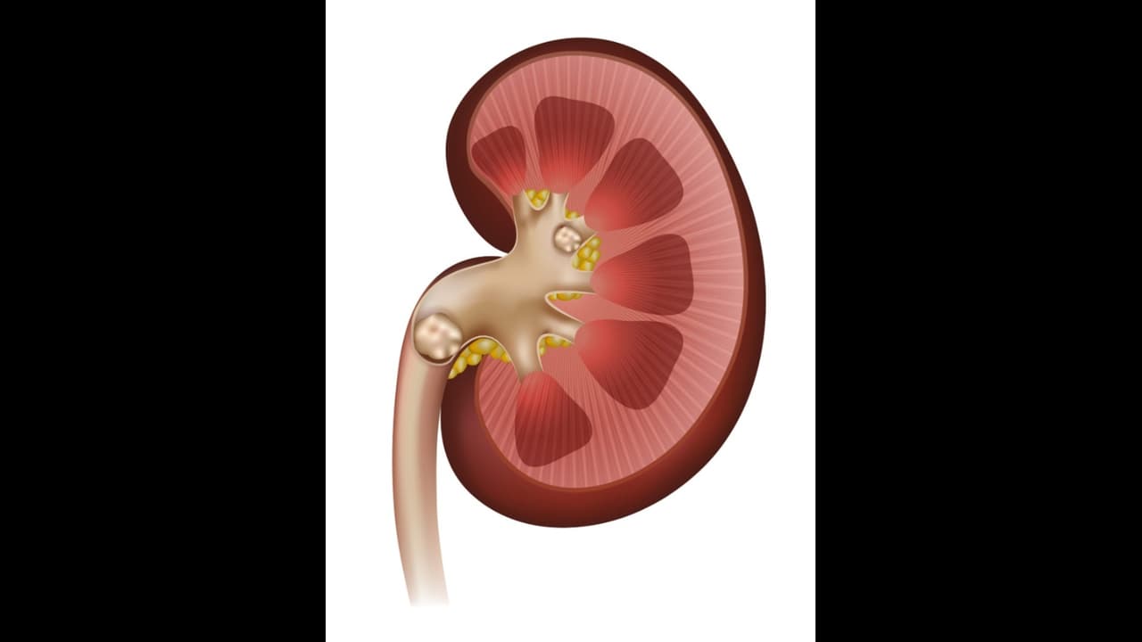 Kidney Stones: ಕಿಡ್ನಿಯಲ್ಲಿ ಕಲ್ಲು ಬೆಳೆಯಲು ಮುಖ್ಯ ಕಾರಣಳು ಇವೇ ನೋಡಿ!