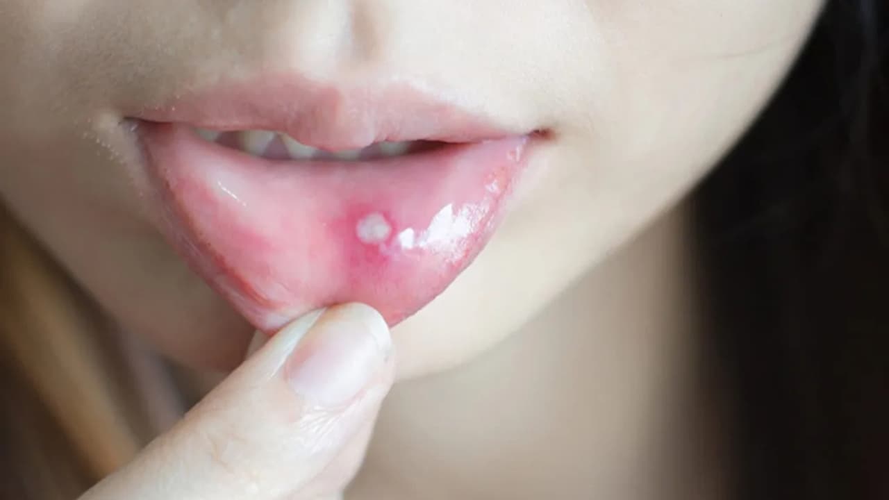 ತಂಬಾಕು, ಗುಟ್ಕಾ ಹೆಚ್ಚು ತಿಂತೀರಾ? ಬಾಯಿ ಕ್ಯಾನ್ಸರ್ ಬರುತ್ತೆ ಹುಷಾರ್! ಈ ಲಕ್ಷಣಗಳಿದ್ರೆ ನೆಗ್ಲೆಕ್ಟ್ ಮಾಡ್ಬೇಡಿ | Early Warning Signs Of Mouth Cancer You Should Not Ignore ತಂಬಾಕು, ಗುಟ್ಕಾ ಹೆಚ್ಚು ತಿಂತೀರಾ? ಬಾಯಿ ಕ್ಯಾನ್ಸರ್ ಬರುತ್ತೆ ಹುಷಾರ್! ಈ ಲಕ್ಷಣಗಳಿದ್ರೆ ನೆಗ್ಲೆಕ್ಟ್ ಮಾಡ್ಬೇಡಿ | Early Warning Signs Of Mouth Cancer You Should Not Ignore