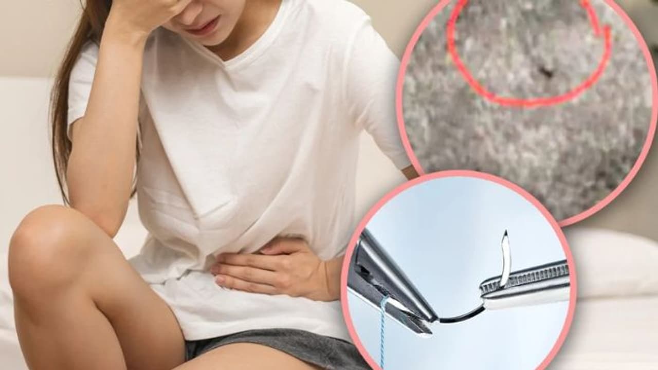 After 18 Years Of Pain From Childbirth Doctor Finds Needle Left Inside ...
