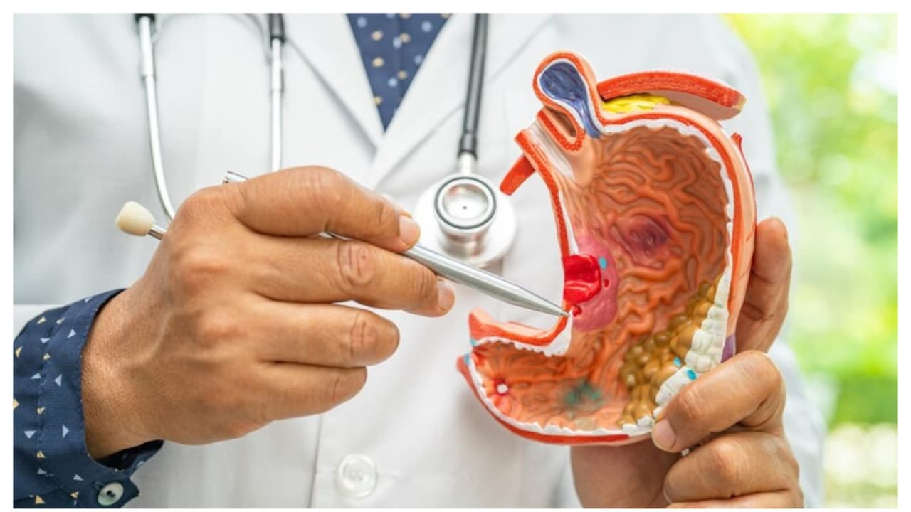 ಹೊಟ್ಟೆಯ ಕ್ಯಾನ್ಸರ್ ಮೊದಲ ಸ್ಟೇಜ್ನಲ್ಲಿದ್ದಾಗ ದೇಹವು ಈ 5 ಸೂಚನೆ ಕೊಡುತ್ತೆ! ಹೊಟ್ಟೆಯ ಕ್ಯಾನ್ಸರ್ ಮೊದಲ ಸ್ಟೇಜ್ನಲ್ಲಿದ್ದಾಗ ದೇಹವು ಈ 5 ಸೂಚನೆ ಕೊಡುತ್ತೆ!