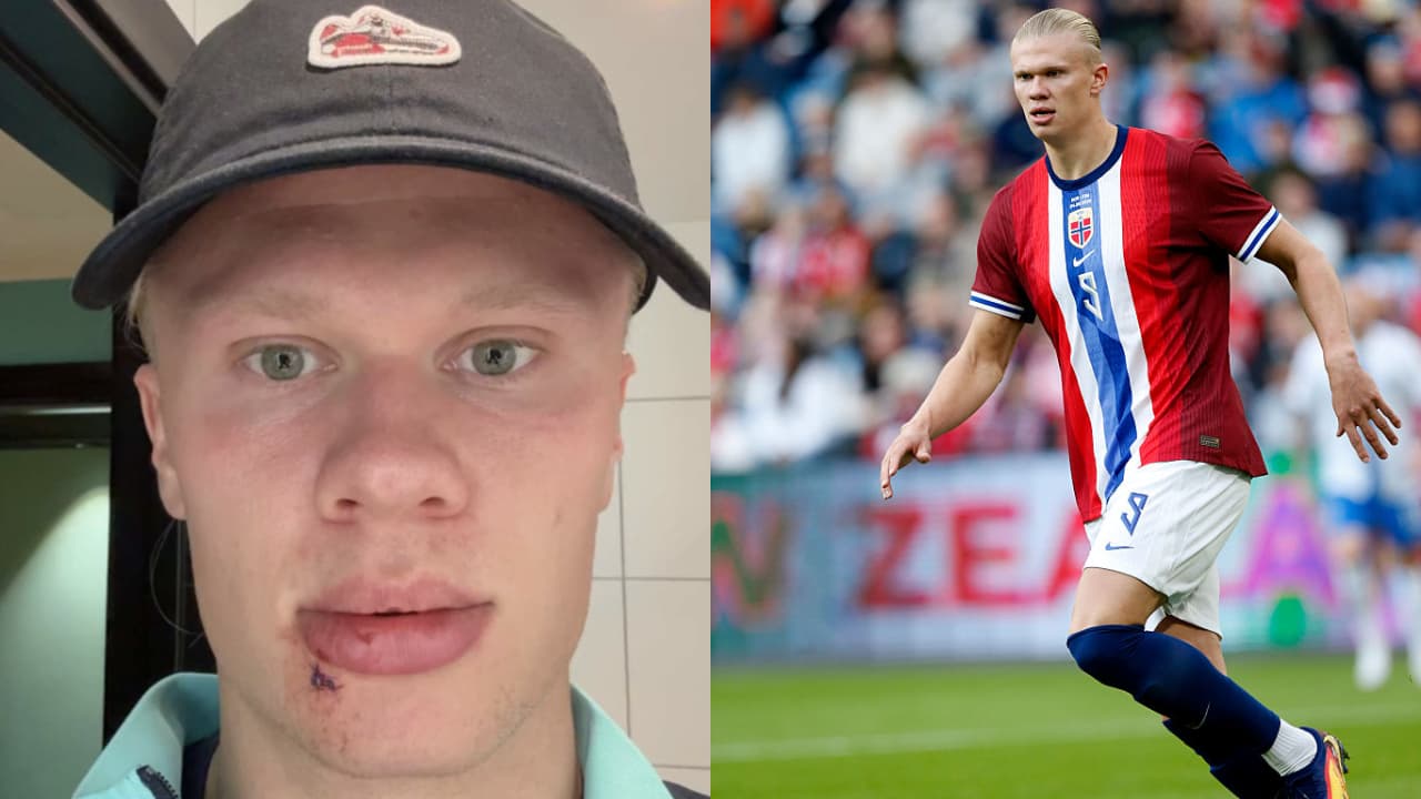 Haaland Joking Blames Odegaard After Freak Accident Leaves Him Needing Stitches