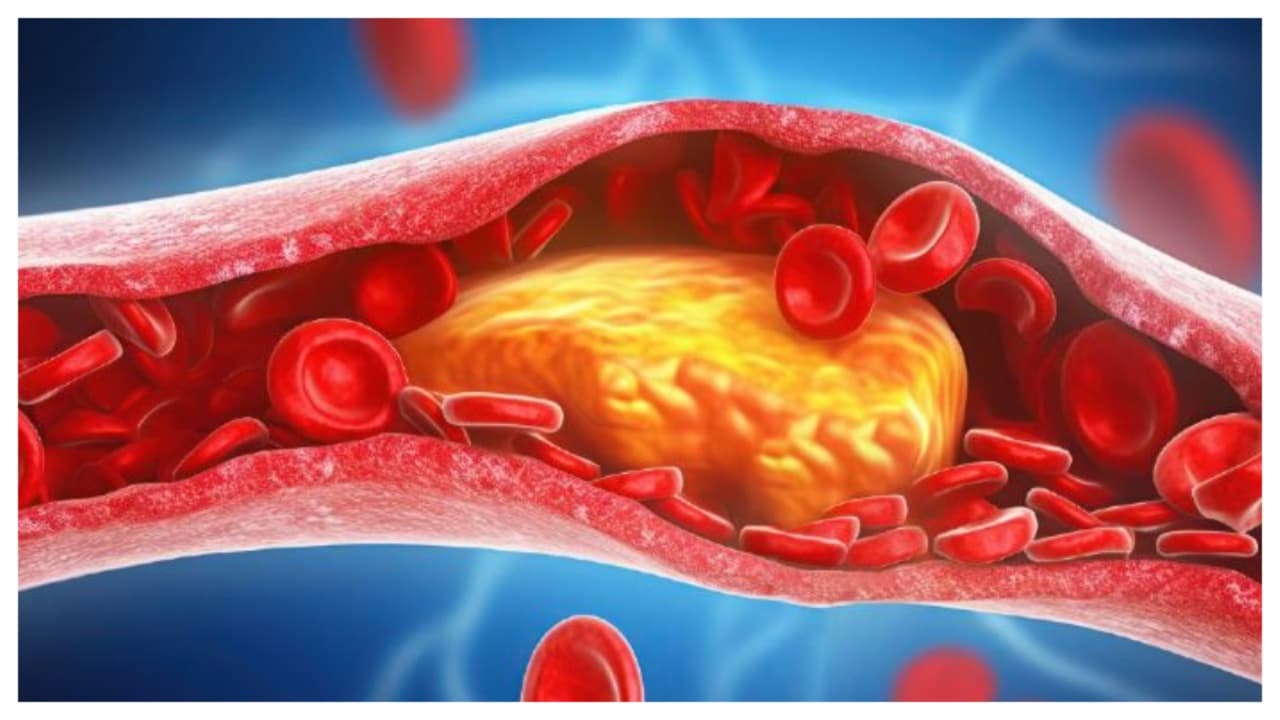 8 Things to Do to Reduce Bad Cholesterol Naturally and Protect Your ...