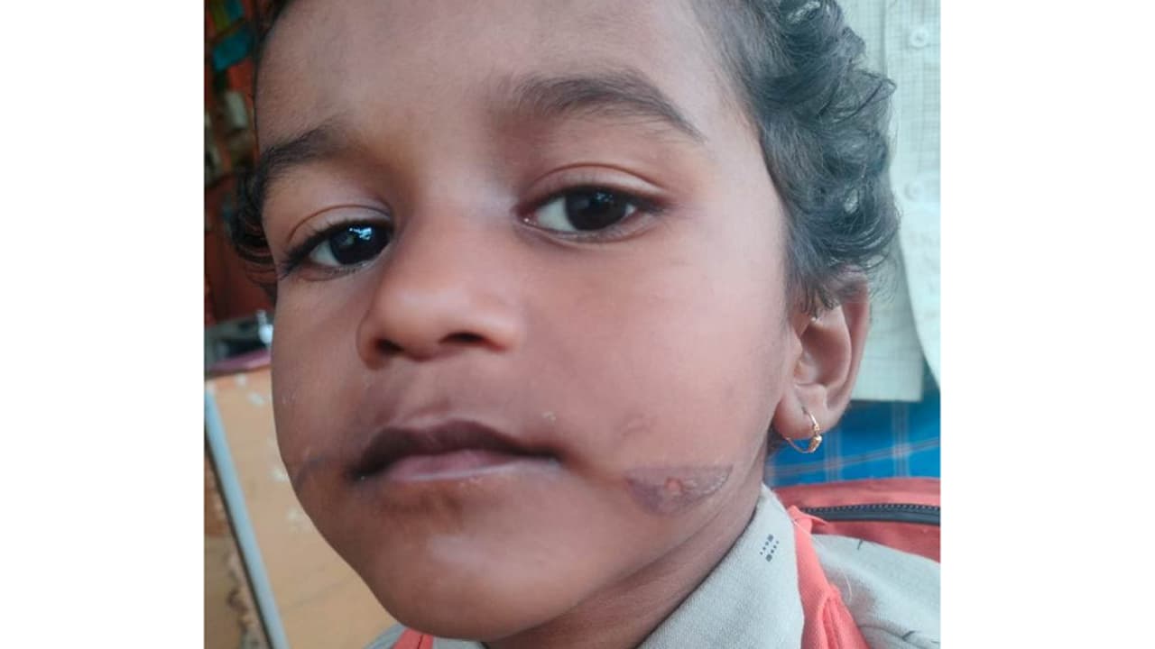 ಸೊರಬದಲ್ಲಿ ಆಘಾತಕಾರಿ ಘಟನೆ: ಕಾದ ಚಾಕುವಿನಿಂದ ಮಗು ಗಲ್ಲಕ್ಕೆ ಬರೆ ಎಳೆದ ಅಂಗನವಾಡಿ ಸಹಾಯಕಿ | Soraba Anganawadi Helper Burns Child Cheek Shivamogga Gvd ಸೊರಬದಲ್ಲಿ ಆಘಾತಕಾರಿ ಘಟನೆ: ಕಾದ ಚಾಕುವಿನಿಂದ ಮಗು ಗಲ್ಲಕ್ಕೆ ಬರೆ ಎಳೆದ ಅಂಗನವಾಡಿ ಸಹಾಯಕಿ | Soraba Anganawadi Helper Burns Child Cheek Shivamogga Gvd