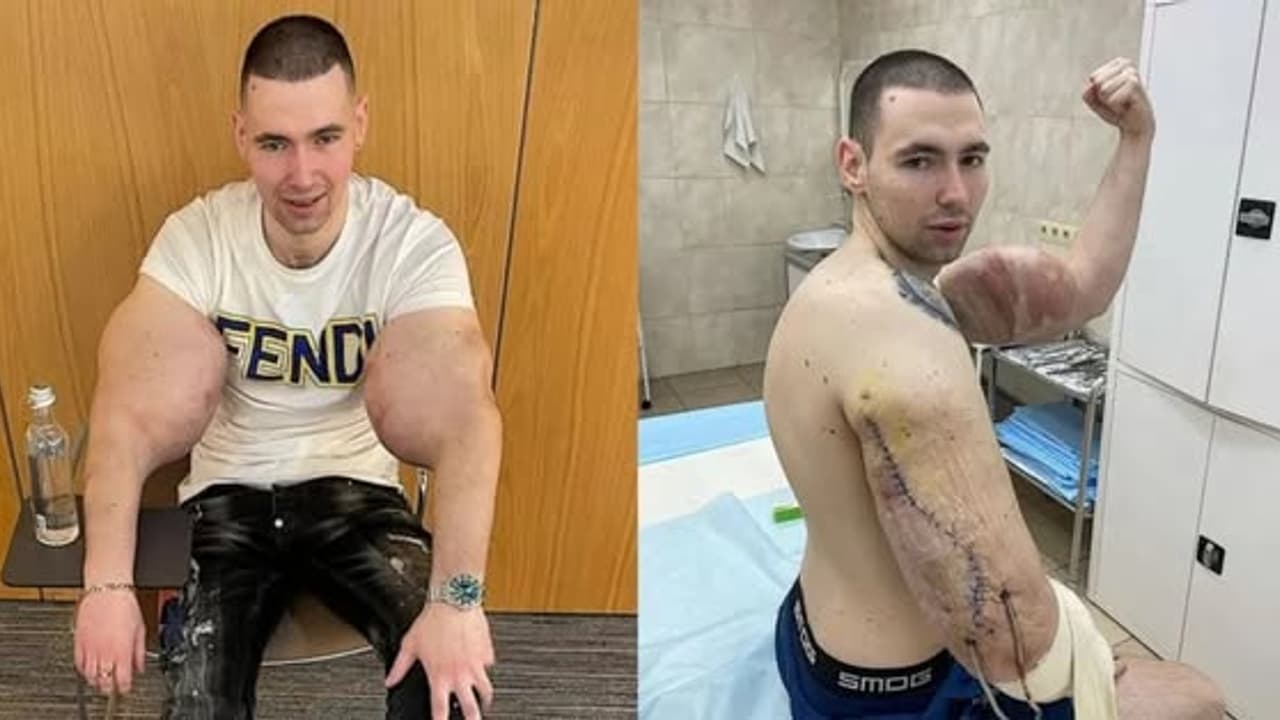 'Russian Popeye' Who Once Injected Vaseline To Increase Biceps Now Could Lose Both Arms