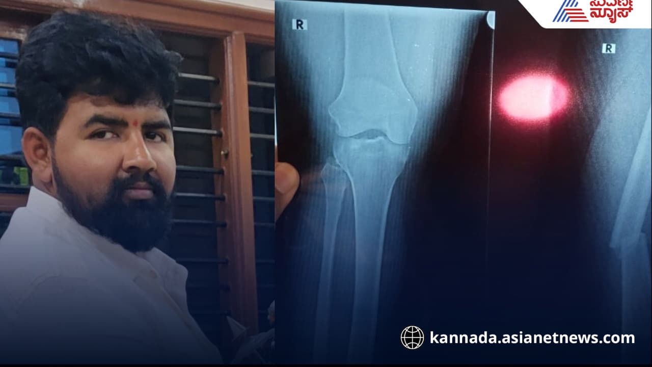 Rapido Bike ಬುಕ್ ಮಾಡುವ ಮುನ್ನ ಎಚ್ಚರ! ರೈಡರ್ ಎಡವಟ್ಟಿಗೆ ಹಿಂಬದಿ ಕುಳಿತ ಗ್ರಾಹಕನ ಮಂಡಿ ಚಿಪ್ಪು ಪುಡಿ ಪುಡಿ! | Be Careful Before Booking Rapido Bike Rider Negligence Accident Bengaluru Rapido Bike ಬುಕ್ ಮಾಡುವ ಮುನ್ನ ಎಚ್ಚರ! ರೈಡರ್ ಎಡವಟ್ಟಿಗೆ ಹಿಂಬದಿ ಕುಳಿತ ಗ್ರಾಹಕನ ಮಂಡಿ ಚಿಪ್ಪು ಪುಡಿ ಪುಡಿ! | Be Careful Before Booking Rapido Bike Rider Negligence Accident Bengaluru