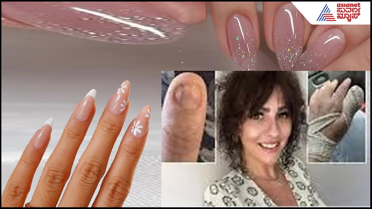 ಅಂದದ ಉಗುರಿಗೆ ಮರುಳಾದ ಮಹಿಳೆಗೆ ಚರ್ಮದ ಕ್ಯಾನ್ಸರ್! ಬೆಚ್ಚಿಬೀಳಿಸ್ತಿದೆ ಈ ಘಟನೆ- ಮಹಿಳೆಯರೇ ಹುಷಾರ್ | Woman Gets Diagnosed With Skin Cancer As She Is Using Acrylic Nails Suc ಅಂದದ ಉಗುರಿಗೆ ಮರುಳಾದ ಮಹಿಳೆಗೆ ಚರ್ಮದ ಕ್ಯಾನ್ಸರ್! ಬೆಚ್ಚಿಬೀಳಿಸ್ತಿದೆ ಈ ಘಟನೆ- ಮಹಿಳೆಯರೇ ಹುಷಾರ್ | Woman Gets Diagnosed With Skin Cancer As She Is Using Acrylic Nails Suc