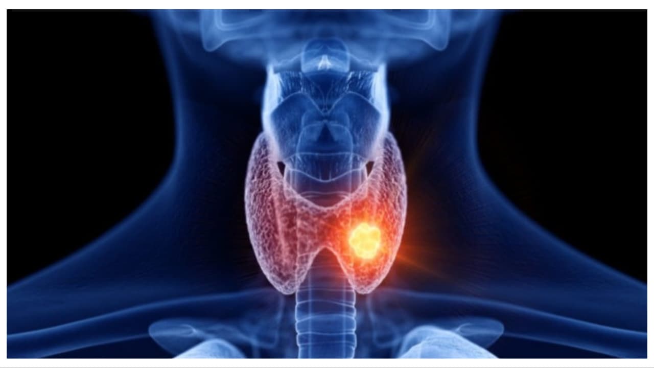 Thyroid Cancer Symptoms: ಥೈರಾಯ್ಡ್ ಕ್ಯಾನ್ಸರ್ನ ಆರಂಭಿಕ ಲಕ್ಷಣಗಳು | Health Life Early Warning Signs Of Thyroid Cancer You Should Not Ignore Thyroid Cancer Symptoms: ಥೈರಾಯ್ಡ್ ಕ್ಯಾನ್ಸರ್ನ ಆರಂಭಿಕ ಲಕ್ಷಣಗಳು | Health Life Early Warning Signs Of Thyroid Cancer You Should Not Ignore