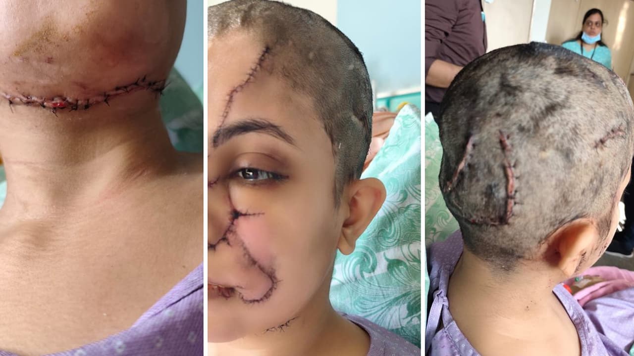 17 ತಿಂಗಳ ಪುಟ್ಟ ಮಗುವಿಗೆ ಮುಖ ತೋರಿಸಲು ಭಯ ಆಗ್ತಿದೆ: ನಾಯಿ ದಾಳಿಯಿಂದಾಗಿ ವಿರೂಪಗೊಂಡ ತಾಯಿಯ ನೋವಿನ ನೋಡಿ | Hsr Layout Dog Attack Case Afraid To Show My Face To Child Mothers Painful Talk 17 ತಿಂಗಳ ಪುಟ್ಟ ಮಗುವಿಗೆ ಮುಖ ತೋರಿಸಲು ಭಯ ಆಗ್ತಿದೆ: ನಾಯಿ ದಾಳಿಯಿಂದಾಗಿ ವಿರೂಪಗೊಂಡ ತಾಯಿಯ ನೋವಿನ ನೋಡಿ | Hsr Layout Dog Attack Case Afraid To Show My Face To Child Mothers Painful Talk