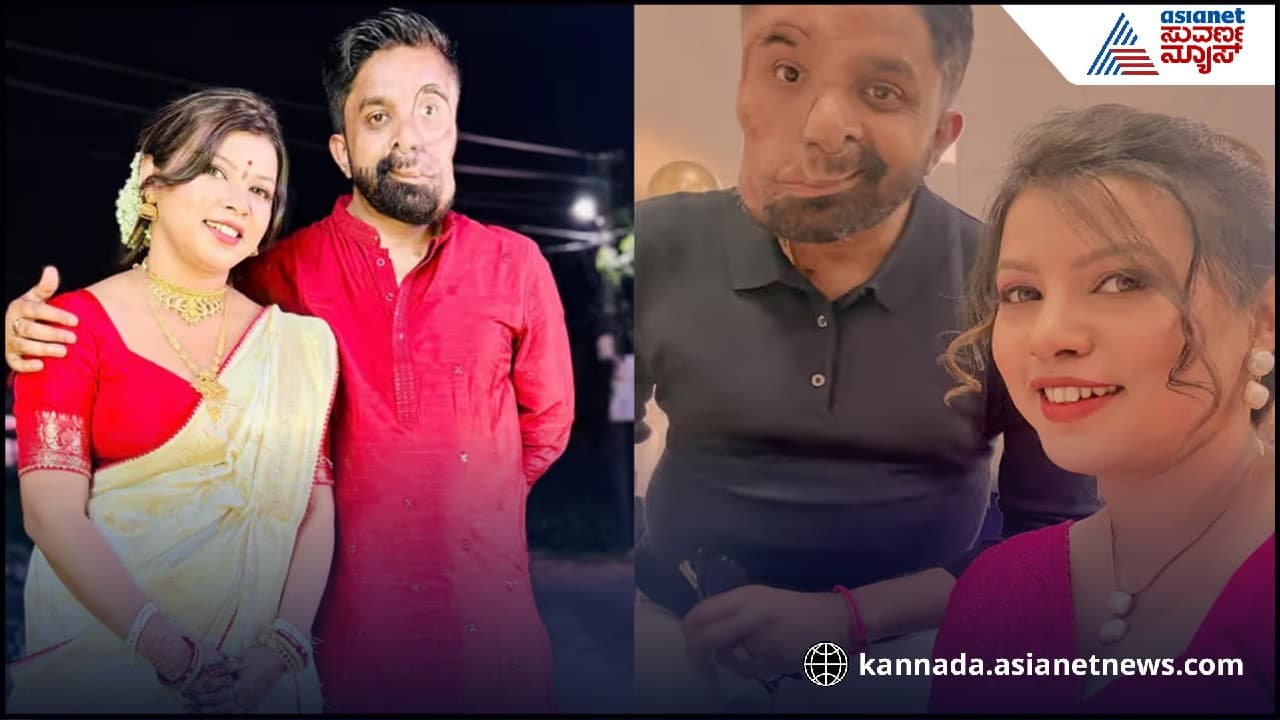 ಅವನ ಮುಖ ಹೀಗಿತ್ತು, ಜಗತ್ತು ತಿರಸ್ಕರಿಸಿತು, ಅವಳು ಪ್ರೀತಿಸಿದಳು! ಹೀಗೊಂದು ಲವ್ ಸ್ಟೋರಿ | Love Story Of Amit Gose Who Become Social Media Star After Married Her Bni ಅವನ ಮುಖ ಹೀಗಿತ್ತು, ಜಗತ್ತು ತಿರಸ್ಕರಿಸಿತು, ಅವಳು ಪ್ರೀತಿಸಿದಳು! ಹೀಗೊಂದು ಲವ್ ಸ್ಟೋರಿ | Love Story Of Amit Gose Who Become Social Media Star After Married Her Bni