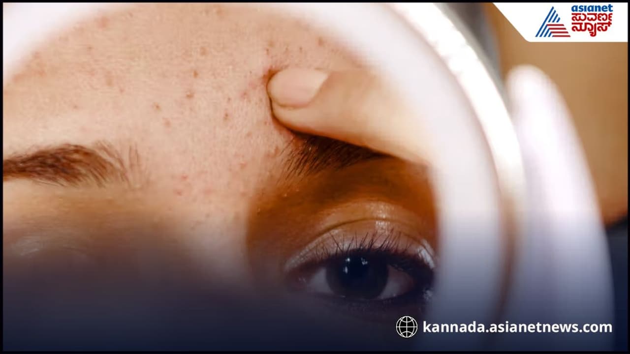 ಮುಖದ ಮೇಲೆ ಬ್ಲ್ಯಾಕ್ ಹೆಡ್ಸ್ ಕಾಣಿಸ್ತಿದ್ರೆ ಪಾರ್ಲರ್ ಗೆ ಓಡ್ಬೇಕಾಗಿಲ್ಲ, ಮನೆಯಲ್ಲೇ ಇದೆ ಟ್ರೀಟ್ಮೆಂಟ್ ಮುಖದ ಮೇಲೆ ಬ್ಲ್ಯಾಕ್ ಹೆಡ್ಸ್ ಕಾಣಿಸ್ತಿದ್ರೆ ಪಾರ್ಲರ್ ಗೆ ಓಡ್ಬೇಕಾಗಿಲ್ಲ, ಮನೆಯಲ್ಲೇ ಇದೆ ಟ್ರೀಟ್ಮೆಂಟ್