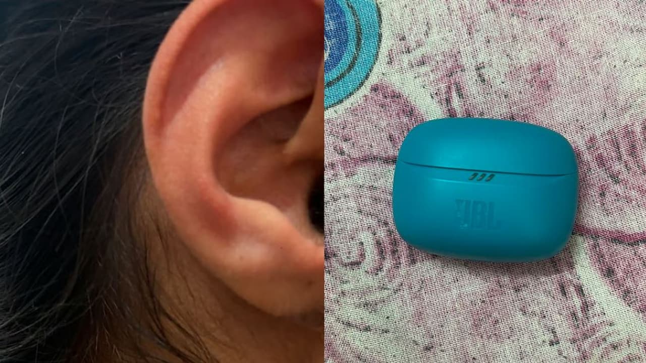 JBL earbud explosion in earಕಿವಿಯೊಳಗೇ ಸಿಡಿದ ಜೆಬಿಎಲ್ ಇಯರ್ ಬಡ್: ಎಂಬಿಬಿಎಸ್ ವಿದ್ಯಾರ್ಥಿನಿಗೆ ಗಂಭೀರ ಗಾಯ | Mbbs Student Injuired After Jbl Earbud Blast While Using JBL earbud explosion in earಕಿವಿಯೊಳಗೇ ಸಿಡಿದ ಜೆಬಿಎಲ್ ಇಯರ್ ಬಡ್: ಎಂಬಿಬಿಎಸ್ ವಿದ್ಯಾರ್ಥಿನಿಗೆ ಗಂಭೀರ ಗಾಯ | Mbbs Student Injuired After Jbl Earbud Blast While Using