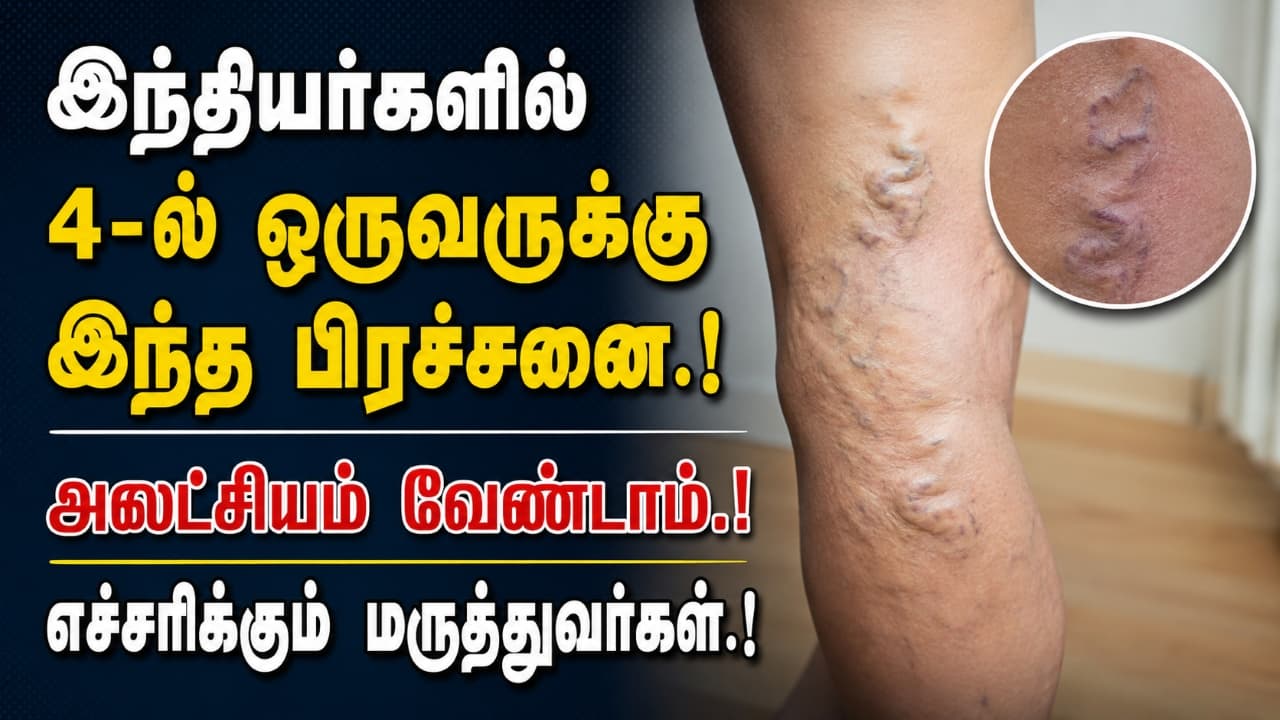 இந்தியர்களில் 4-ல் ஒருவருக்கு வெரிகோஸ் வெயின்: மருத்துவர்கள் எச்சரிக்கை