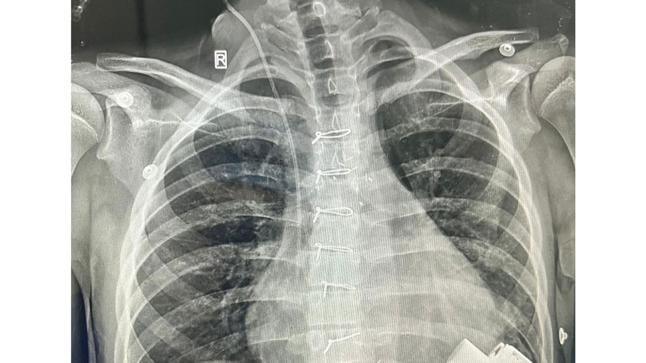 Uzbek boy, 14, becomes India's youngest mechanical heart recipient