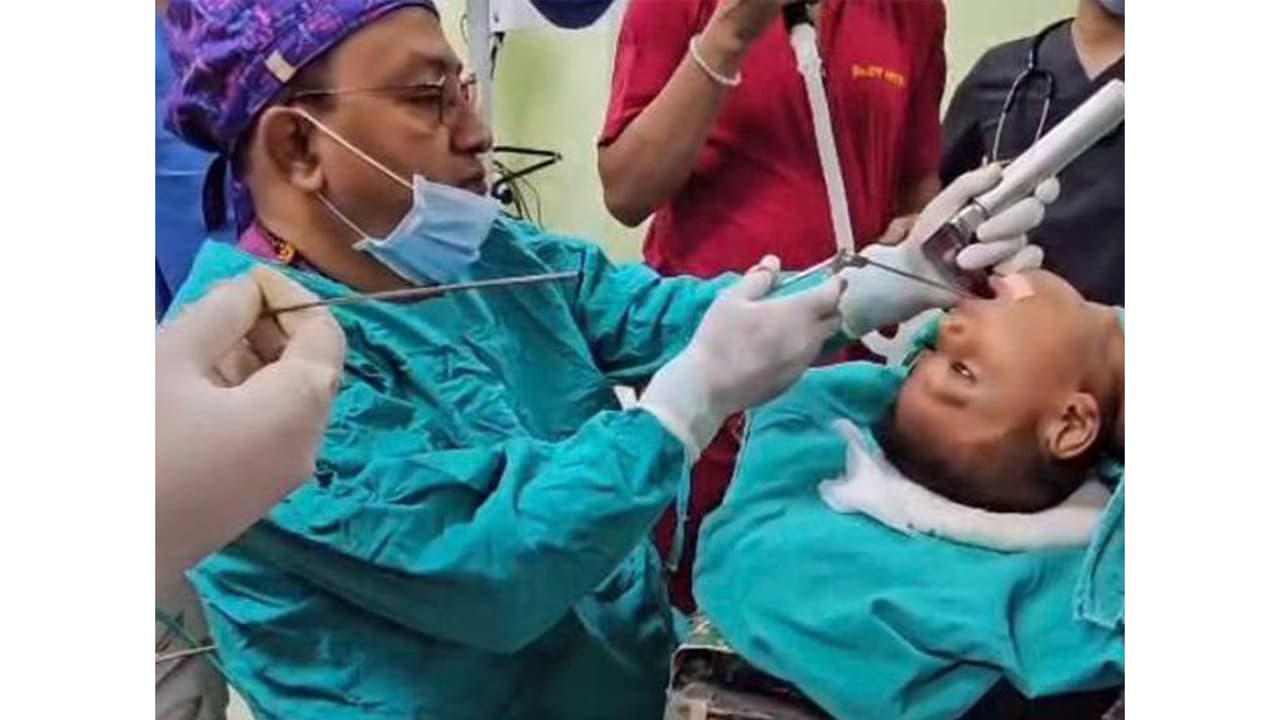 Medical Team in Agartala Removes Coin From Child Food Pipe on Holiday
