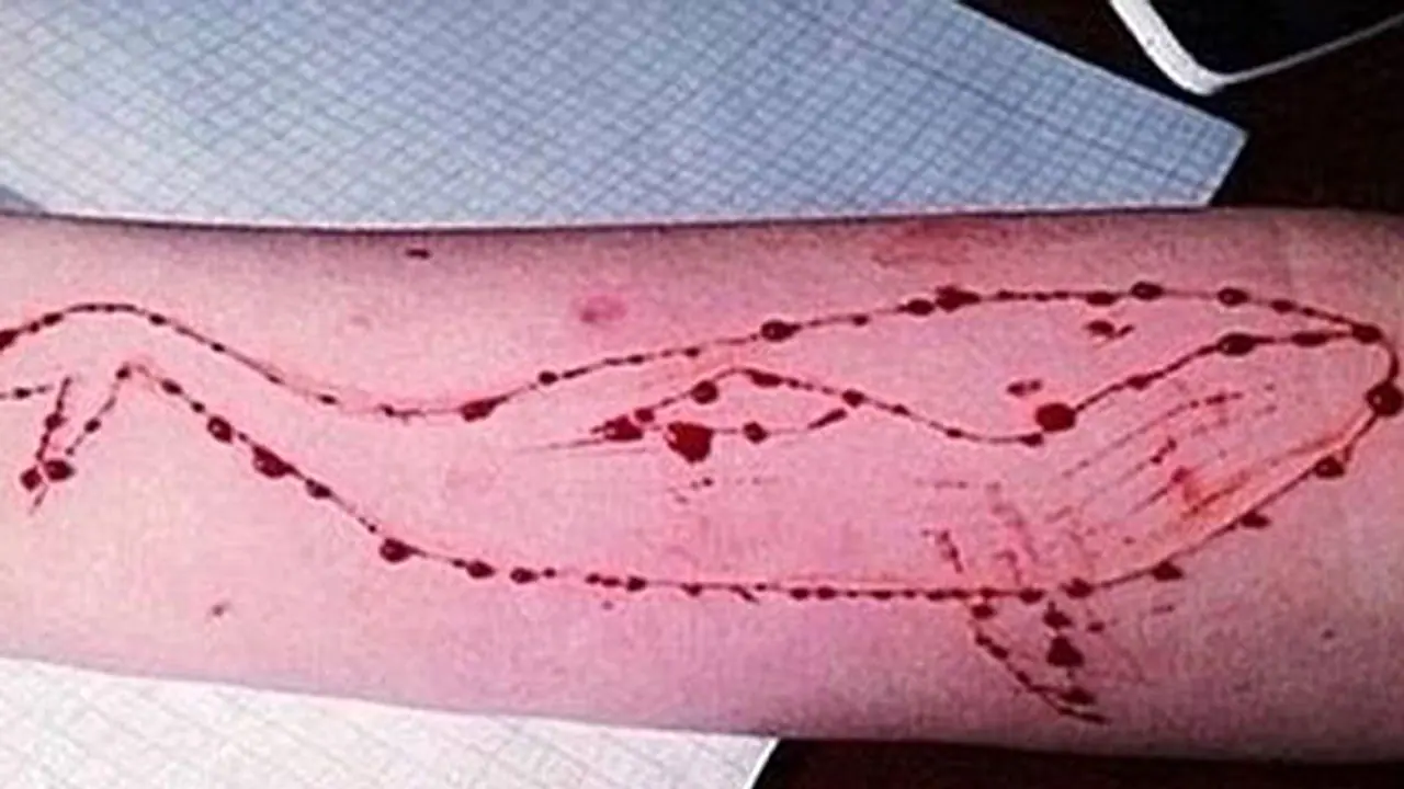 Suicide game enters Mangalore, child with Blue Whale injury found Suicide game enters Mangalore, child with Blue Whale injury found