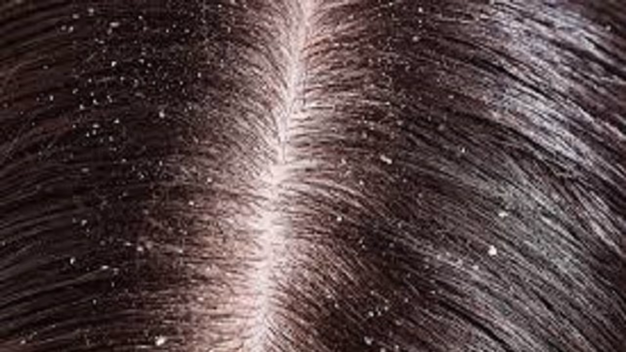 ಕೇಶವನ್ನು ಕೇರ್ಫುಲ್ ಆಗಿ ಕಾಪಾಡಿಕೊಳ್ಳೋದು ಹೇಗೆ? ಕೇಶವನ್ನು ಕೇರ್ಫುಲ್ ಆಗಿ ಕಾಪಾಡಿಕೊಳ್ಳೋದು ಹೇಗೆ?