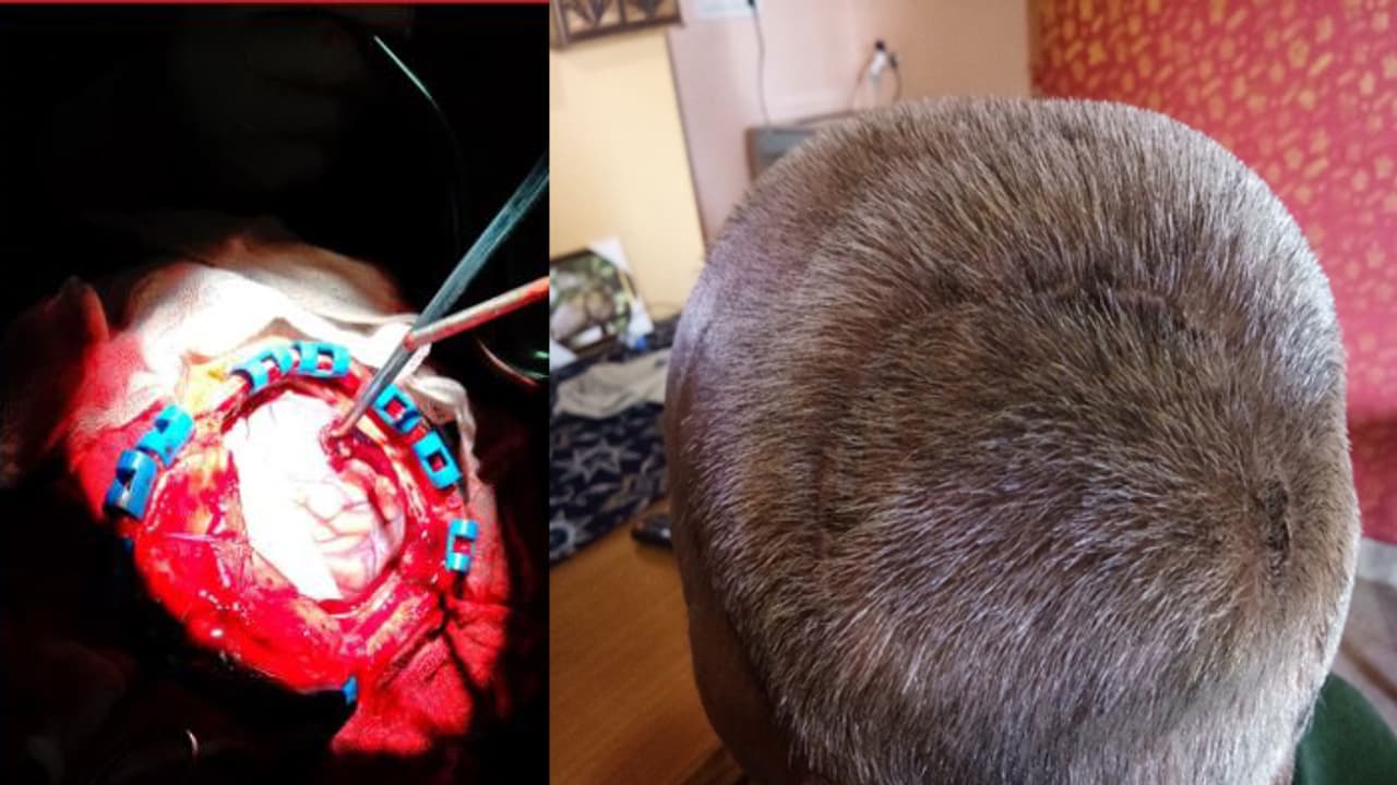 ಆಪರೇಷನ್ ಟೈಮಲ್ಲಿ ತಲೆ ಚಿಪ್ಪು ಮಿಸ್ ಮಾಡಿದ ವೈದ್ಯ ಆಪರೇಷನ್ ಟೈಮಲ್ಲಿ ತಲೆ ಚಿಪ್ಪು ಮಿಸ್ ಮಾಡಿದ ವೈದ್ಯ