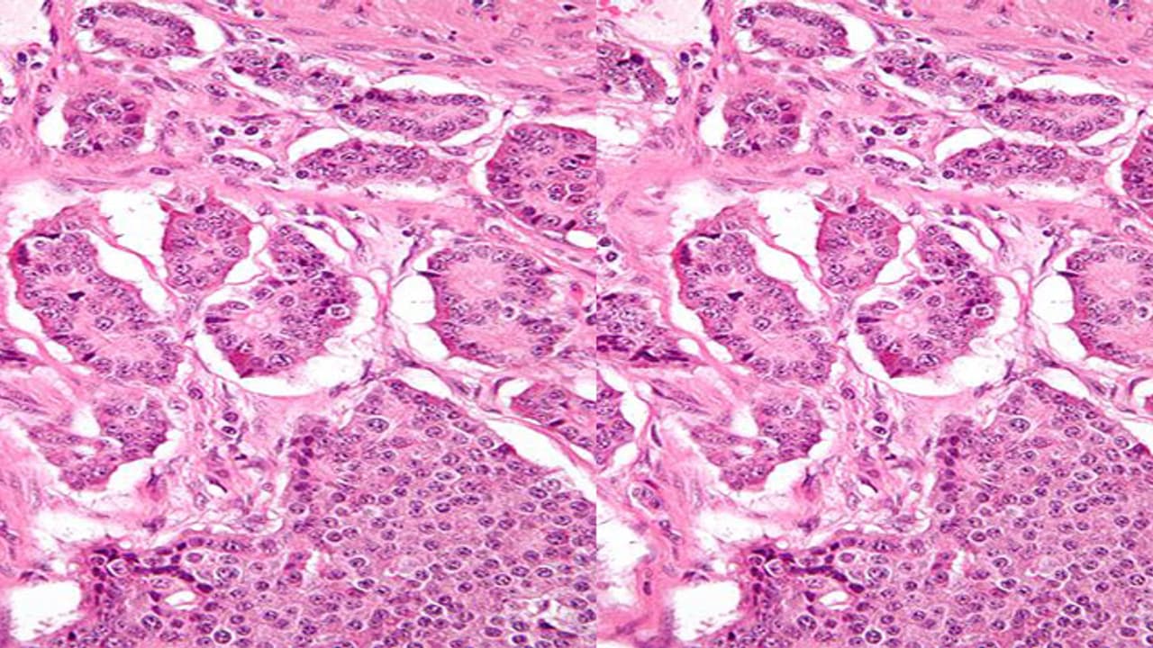 ಇರ್ಫಾನ್ ಖಾನ್’ಗೆ ಬಂದ ಕ್ಯಾನ್ಸರ್’ಗೆ ಚಿಕಿತ್ಸೆ ಇಲ್ವಾ?