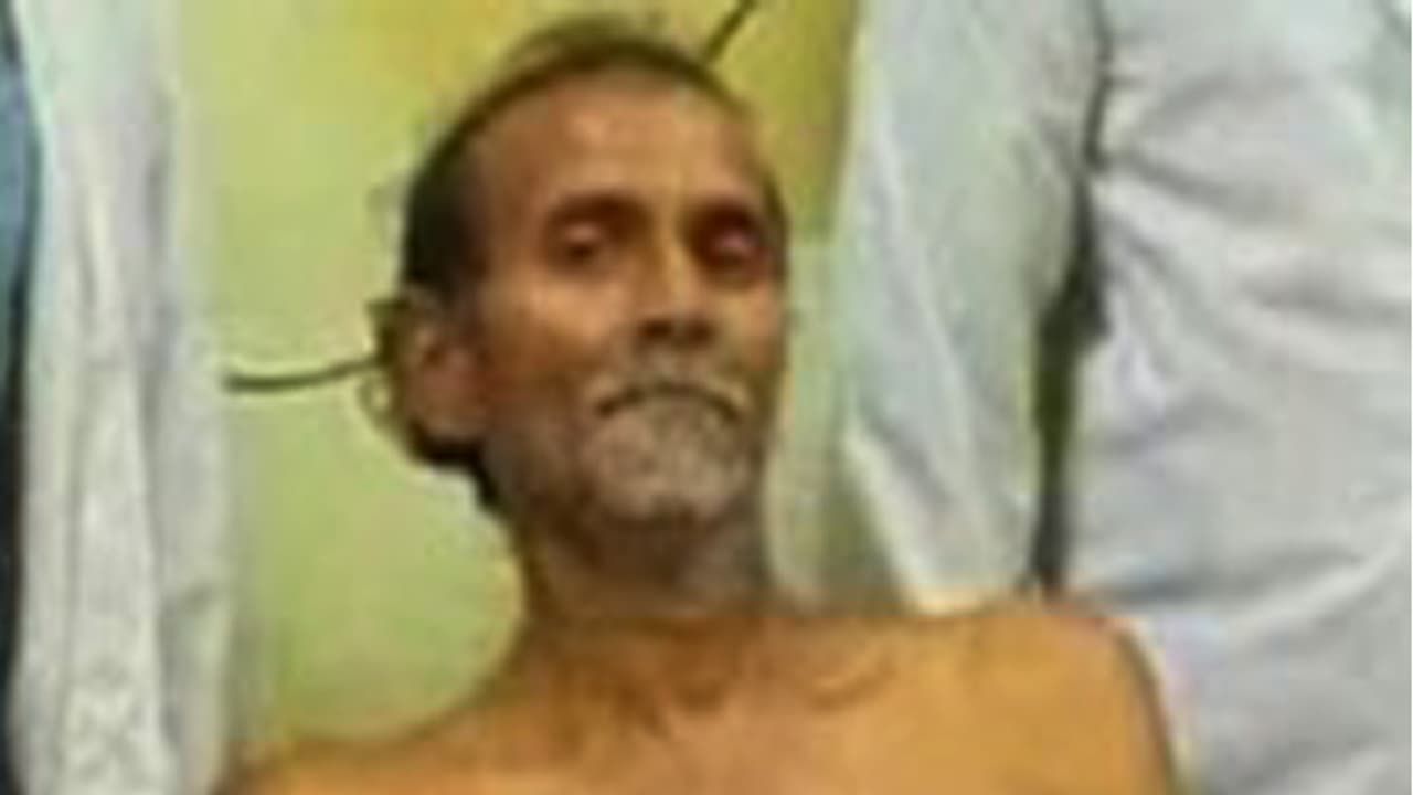 రోగి కడుపు నుండి స్టీల్ గ్లాస్ వెలికి తీసిన వైద్యులు