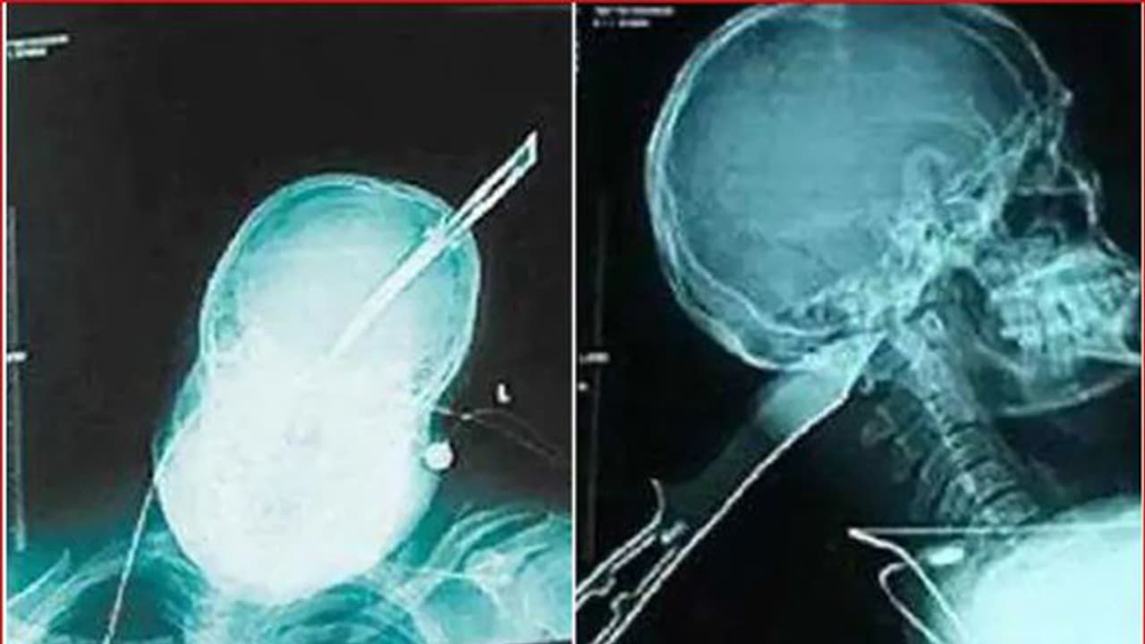 ತಮಾಷೆಯಲ್ಲ: ತಲೆಗೆ ಚಾಕು ಹೊಕ್ಕಿದ್ದರೂ ಬೈಕ್ ಓಡಿಸಿ ಬದುಕುಳಿದ ಭೂಪ! ತಮಾಷೆಯಲ್ಲ: ತಲೆಗೆ ಚಾಕು ಹೊಕ್ಕಿದ್ದರೂ ಬೈಕ್ ಓಡಿಸಿ ಬದುಕುಳಿದ ಭೂಪ!