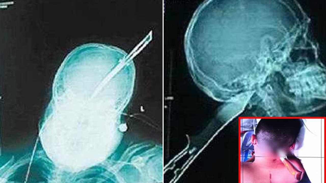 తలలో కత్తి .. పట్టించుకోని జనాలు.. ప్రాణాల కోసం బైక్పై పోలీస్స్టేషన్కు తలలో కత్తి .. పట్టించుకోని జనాలు.. ప్రాణాల కోసం బైక్పై పోలీస్స్టేషన్కు