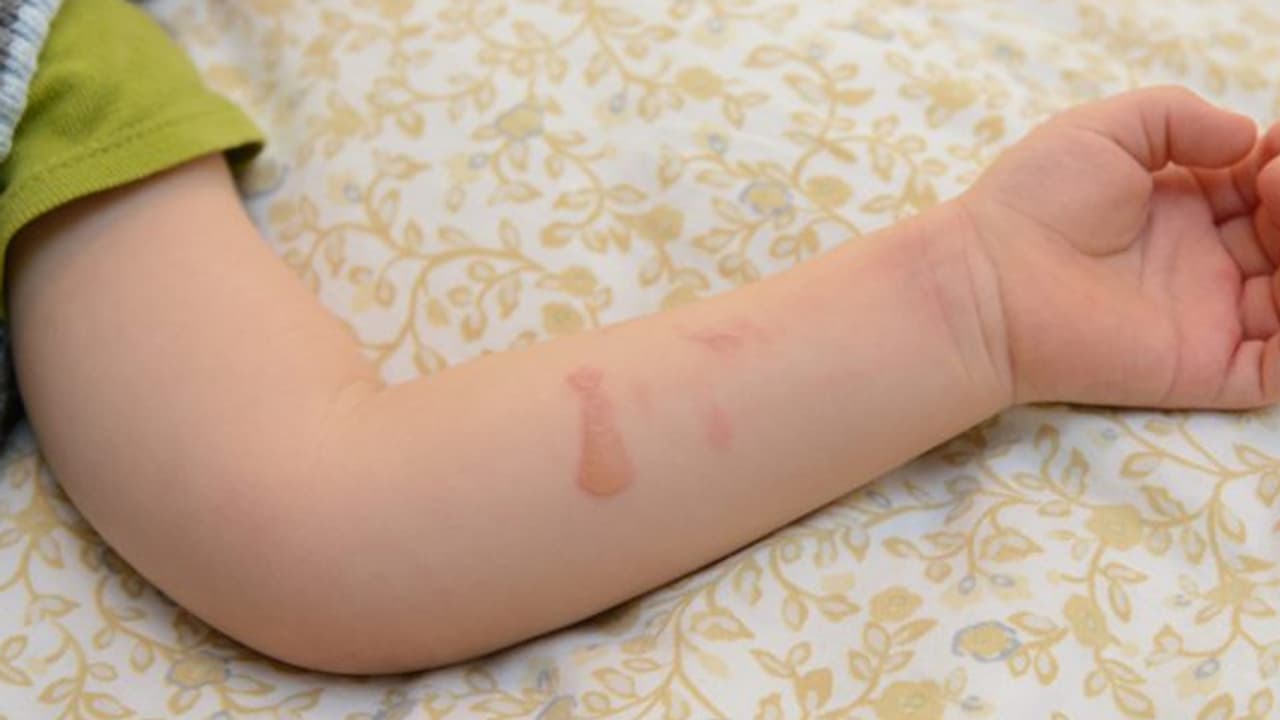 ఎంతైనా సవతి తల్లి సవతి తల్లే... నిద్రలో పక్క తడుపుతోందని చిన్నారికి వాతలు ఎంతైనా సవతి తల్లి సవతి తల్లే... నిద్రలో పక్క తడుపుతోందని చిన్నారికి వాతలు