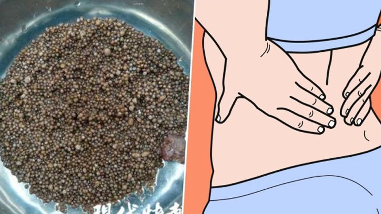 కిడ్నీలో 1,72,155 రాళ్లు.. గిన్నిస్ బుక్లోకి భారతీయుడు కిడ్నీలో 1,72,155 రాళ్లు.. గిన్నిస్ బుక్లోకి భారతీయుడు