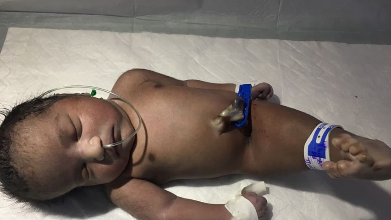 ವೈದ್ಯಲೋಕಕ್ಕೆ ಸವಾಲು; ಅಪರೂಪದ ಮಗು ಜನನ ವೈದ್ಯಲೋಕಕ್ಕೆ ಸವಾಲು; ಅಪರೂಪದ ಮಗು ಜನನ