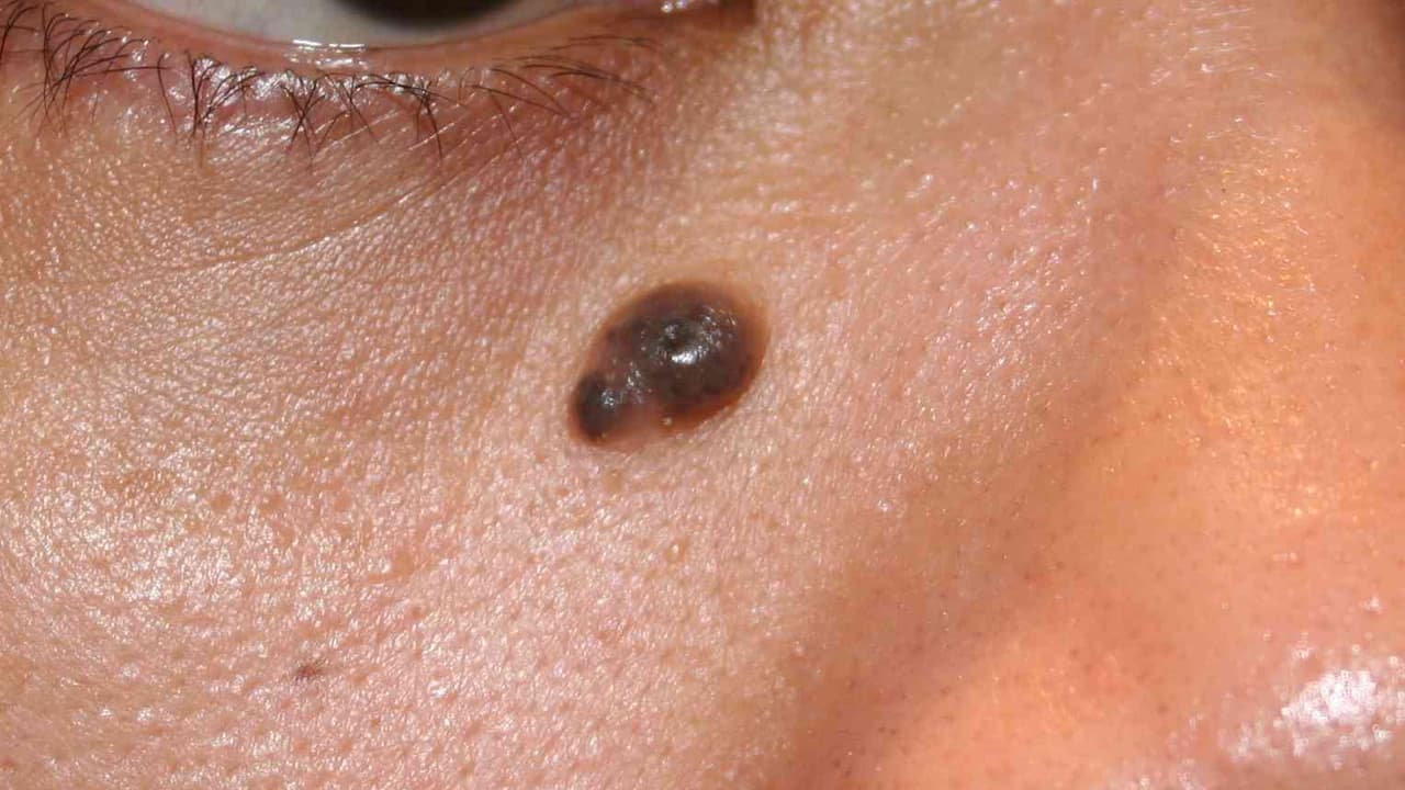 உங்கள் உடல் மட்டுமல்ல....முகத்திலும் மருவா..? இதோ ஒரே ஒரு தீர்வு..! உங்கள் உடல் மட்டுமல்ல....முகத்திலும் மருவா..? இதோ ஒரே ஒரு தீர்வு..!