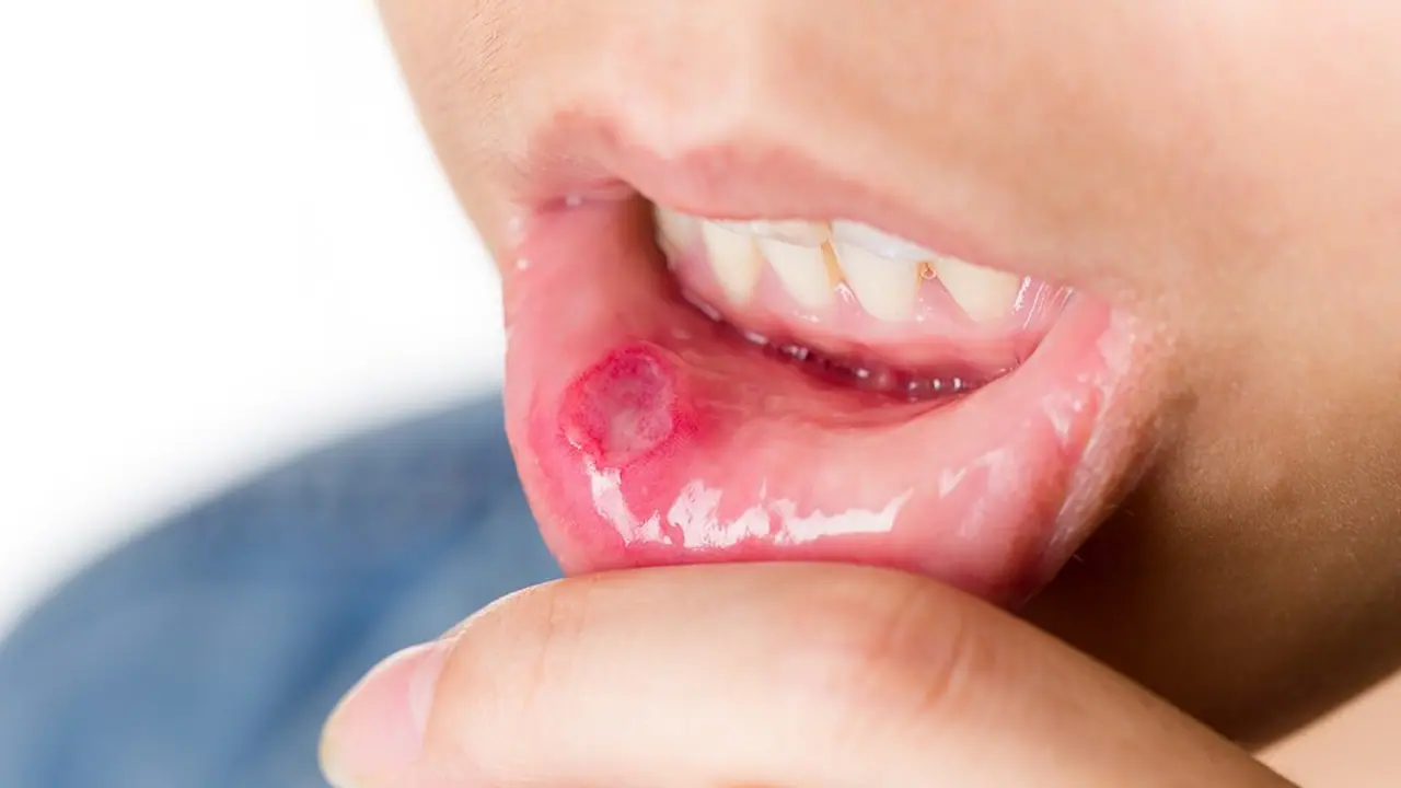 Home Remedies for Mouth Ulcers : വായ്പ്പുണ്ണ് ഇടയ്ക്കിടെ വരാറുണ്ടോ? എങ്കിൽ ഇവ ഉപയോ​ഗിച്ചാൽ മതി