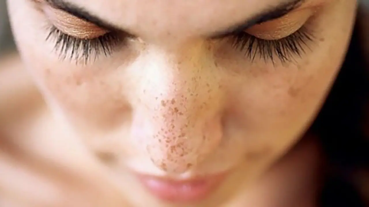 முகத்தில் அசிங்கமா தோன்றும் கரும்புள்ளிக்கு சூப்பர் தீர்வு..!