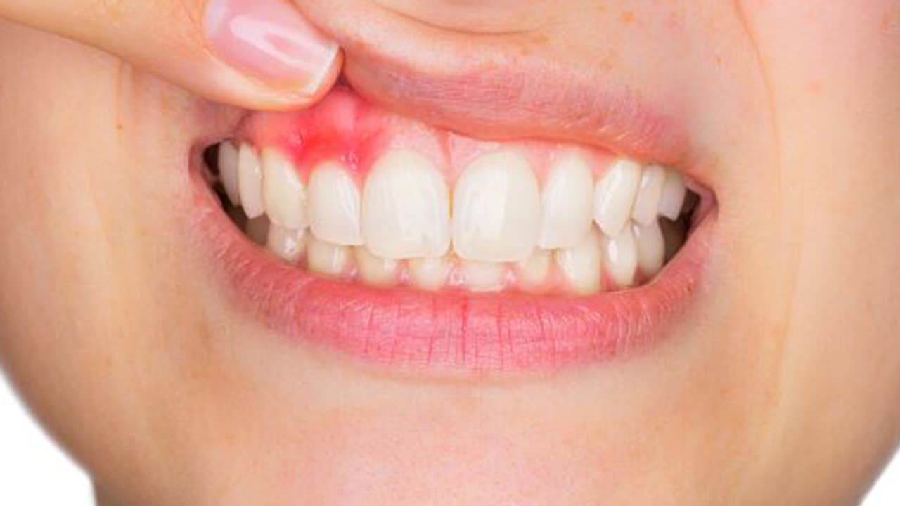 മോണയിൽ നിന്ന് രക്തം വരാറുണ്ടോ? മോണയിൽ നിന്ന് രക്തം വരാറുണ്ടോ?