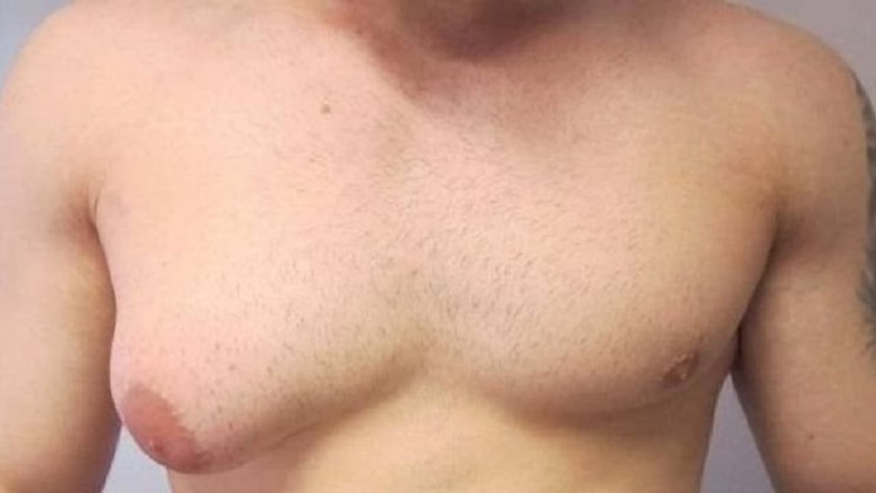 ಹುಡುಗರಲ್ಲಿ ಸ್ತನದ ಗಾತ್ರ ಹೆಚ್ಚಾಗಲು ಕಾರಣವೇನು? ಹುಡುಗರಲ್ಲಿ ಸ್ತನದ ಗಾತ್ರ ಹೆಚ್ಚಾಗಲು ಕಾರಣವೇನು?