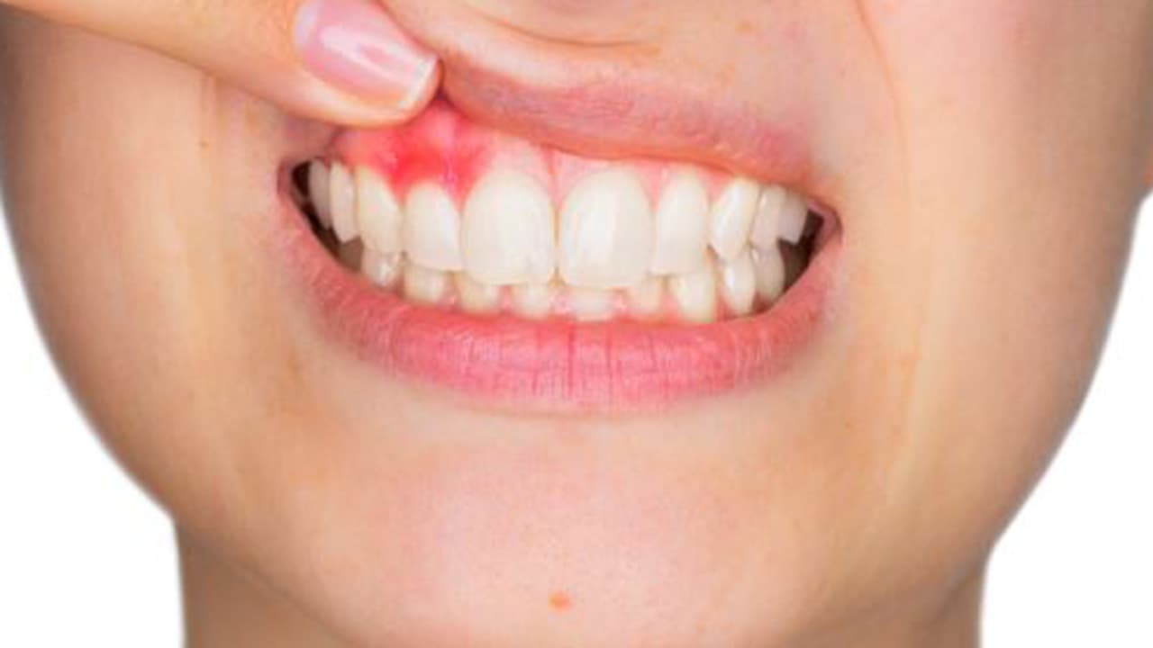 গাম ব্লিডিং এর সমস্যা, ব্রাশ করার সময় মেলে চলুন এই পদ্ধতিগুলি গাম ব্লিডিং এর সমস্যা, ব্রাশ করার সময় মেলে চলুন এই পদ্ধতিগুলি