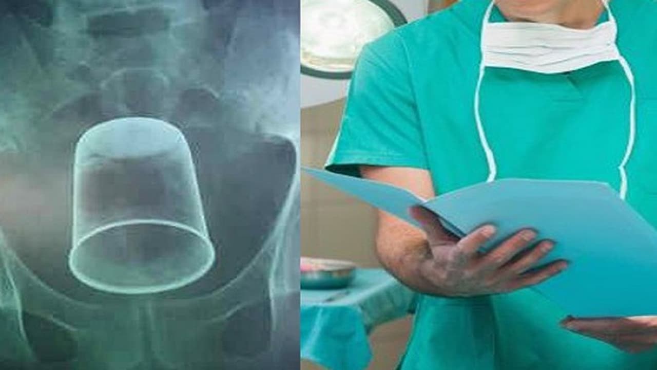 ಲೋಟ ಗುದದ್ವಾರದ ಮೂಲಕ ಗಂಡಸಿನ ಹೊಟ್ಟೆ ಸೇರಿದ್ದೇಗೆ? ಲೋಟ ಗುದದ್ವಾರದ ಮೂಲಕ ಗಂಡಸಿನ ಹೊಟ್ಟೆ ಸೇರಿದ್ದೇಗೆ?