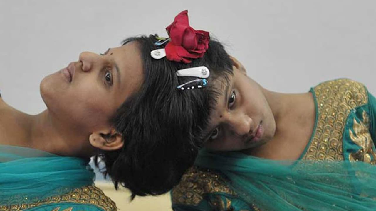 మారని స్థితి: 16 ఏట అడుగుపెట్టిన వీణా.. వాణీ మారని స్థితి: 16 ఏట అడుగుపెట్టిన వీణా.. వాణీ